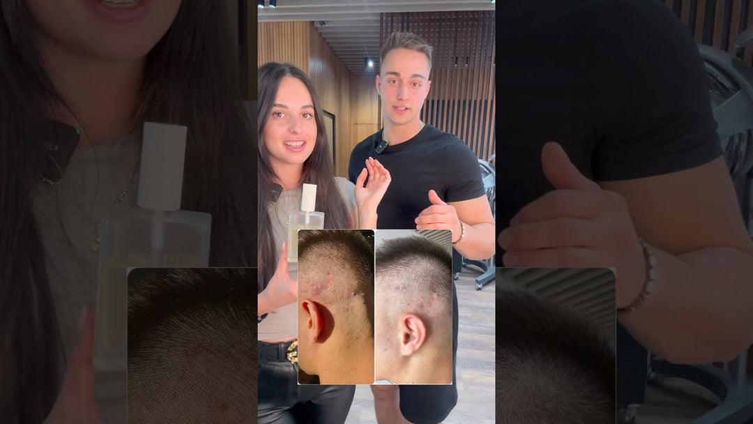 Psoriasis 